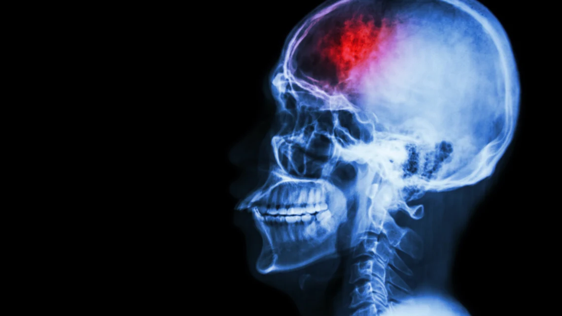 What is Second Impact Syndrome Brain Injury?